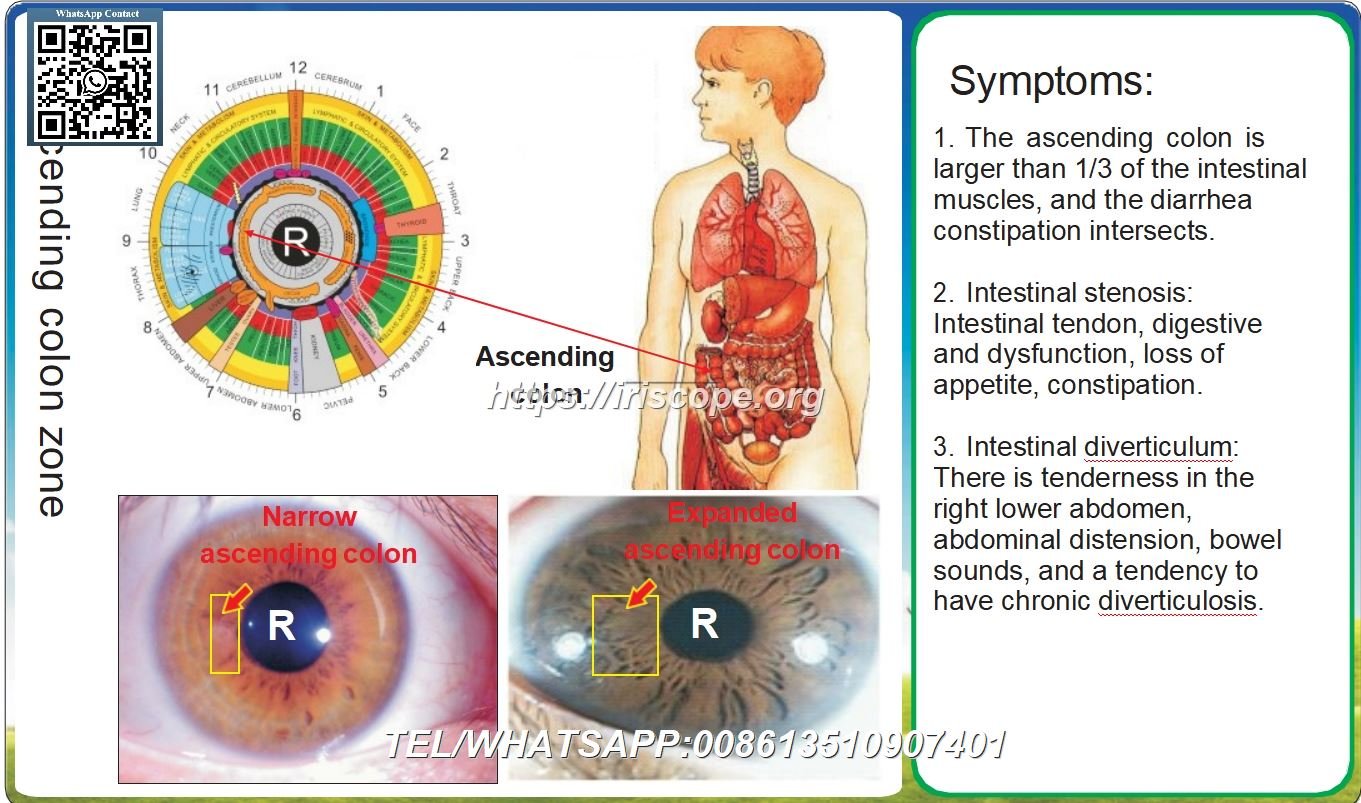 8.1 Iridologie: Vernauwd Colon Ascendens en Verwijdd Colon Ascendens – Casus 4