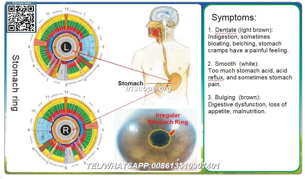 Hoofdstuk 8 Irisdiagnostiek reflectiezone en de acht lichaamsystemen – 8.1 Spijsverteringsstelsel Casus 2