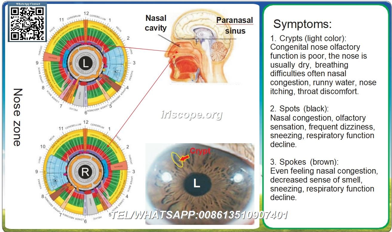 Hoofdstuk 8 Iridologie reflectiezone en de acht lichaamsystemen – 8.1 Ademhalingssysteem Casus 1