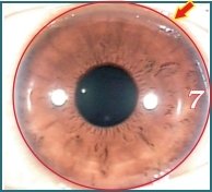 Illustratie van Iridologie – 3.6 Huidmetabolisme Ring