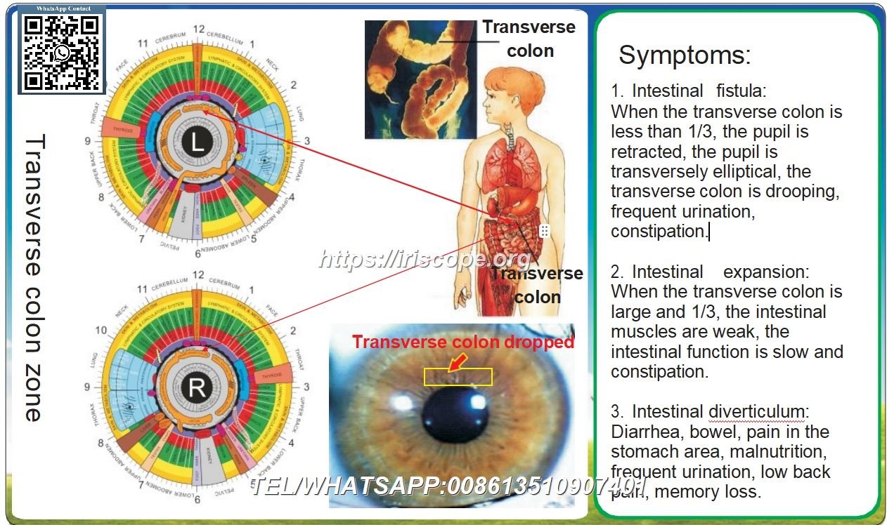 8.1 Iridologie – Het Transversum Colon: Casusstudie 8