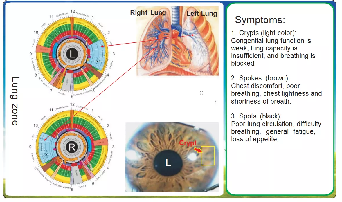 Iridologie en Longgezondheid – Een Diepgaande Analyse van Irispatronen
